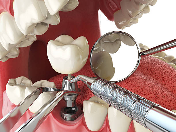 Best Emergency Root Canal Treatment in Burns Flat, OK